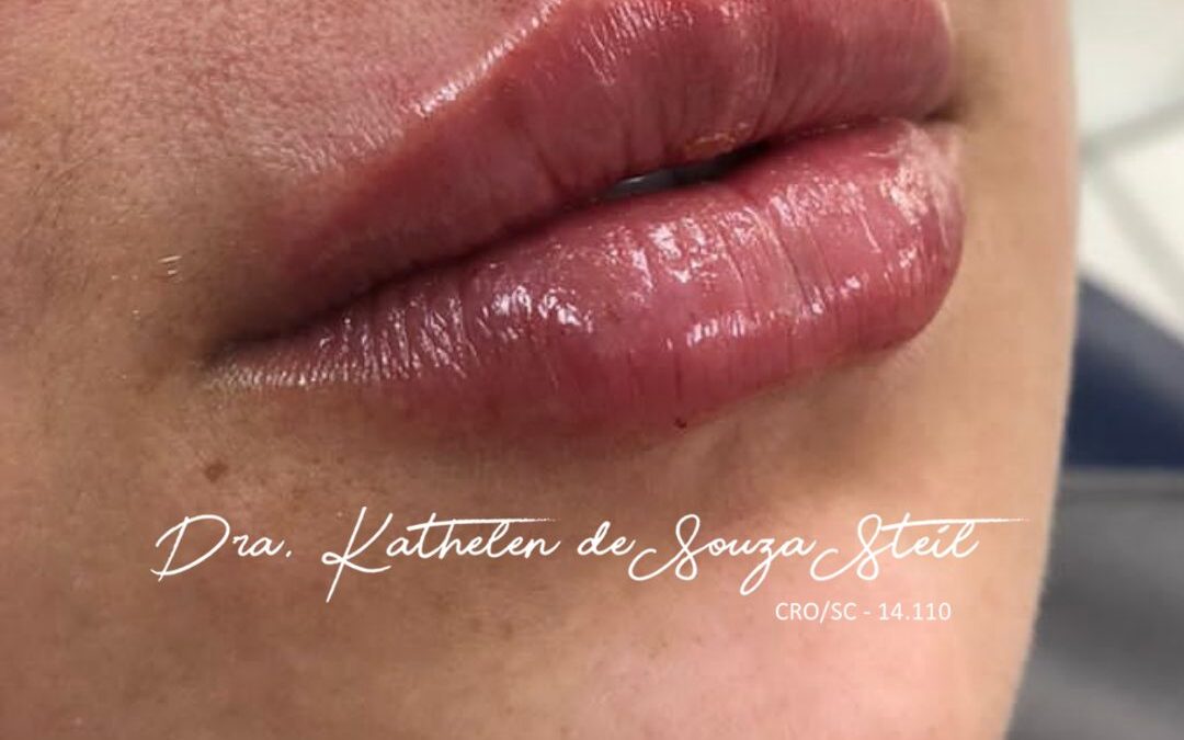 Dói fazer preenchimento labial?