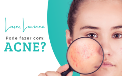 Pode fazer laser Lavieen com acne?