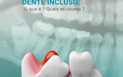 O que são Dentes Inclusos?