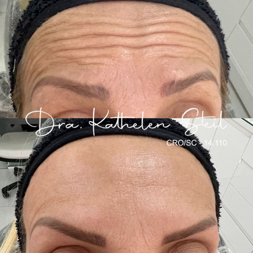 Botox