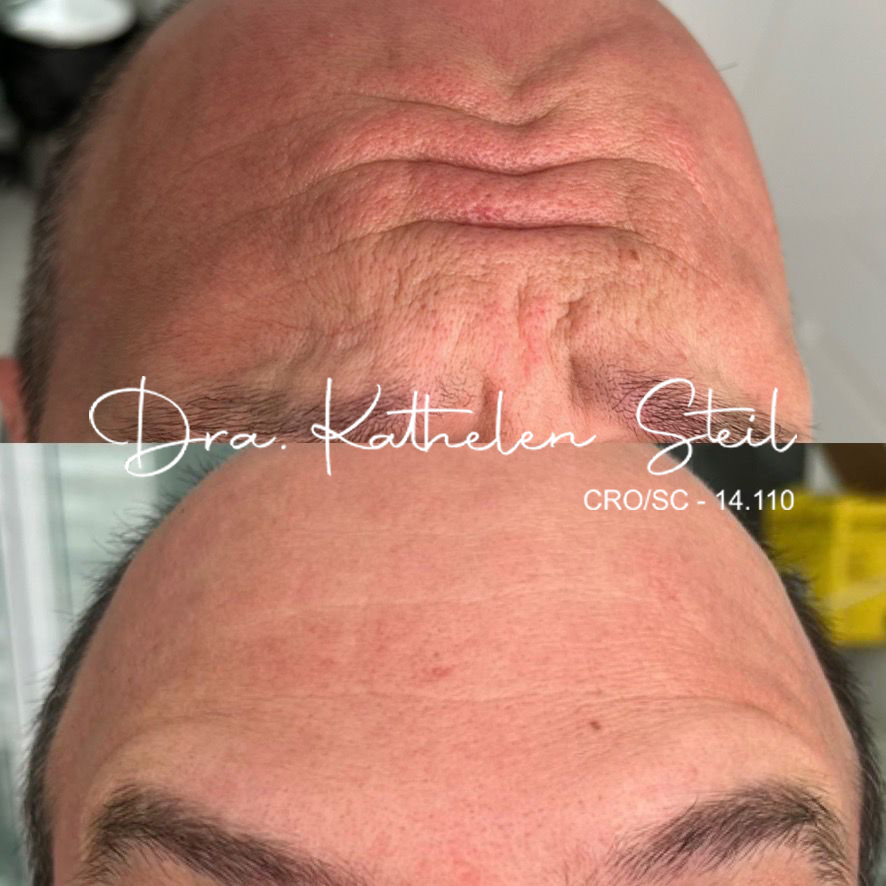 Botox