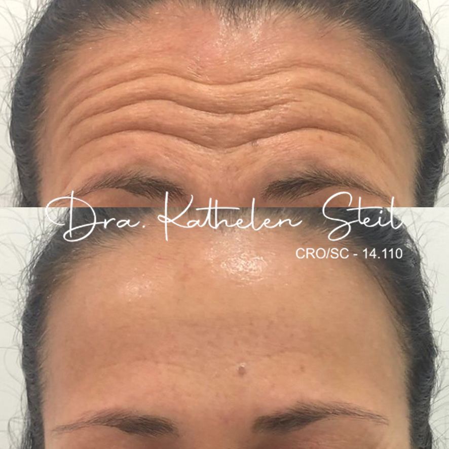 Botox