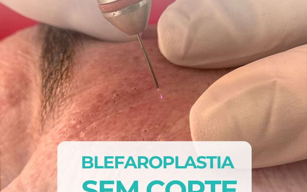 Tudo o que você precisa saber sobre Blefaroplastia sem corte